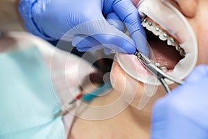 Orthodontics. The dentist carries out the procedure for servicing braces in the patient