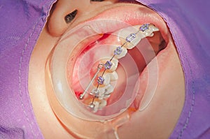 Orthodontics procedure with miniscrew.