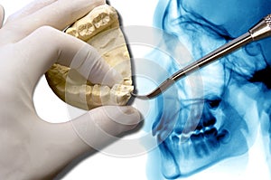 Orthodontics tool show molar tooth over x-ray