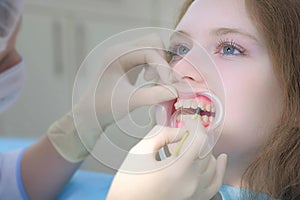 Orthodontist covering special gel on woman teeth in dentistry using brush.