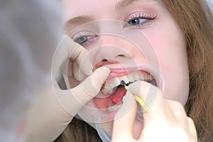 Orthodontist covering special gel on woman teeth in dentistry using brush.