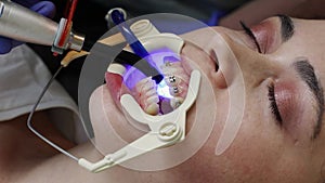 Orthodontist fixes ligature braces on teeth of young woman. Close up of Caucasian woman at appointment in dental clinic