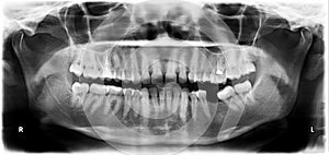 Orthopantomogram of the dentition photo