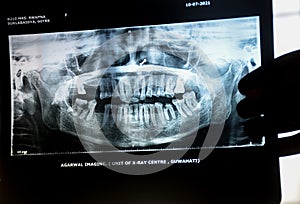 Orthopantomogram (OPG) x-ray of teeth holding in hand against light .