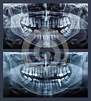 Orthopantomograph panoramic image radiograph of teeth