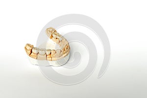 Orthopedic dentistry. tooth replacement concept. dental prosthetics. cermet teeth. ceramic bridges. gypsum model of the jaw and