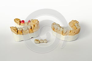 orthopedic dentistry. tooth replacement concept. dental prosthetics. cermet teeth. ceramic bridges. gypsum model of the jaw and