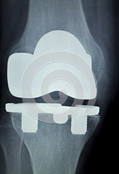 Orthopedic knee implant Xray scan