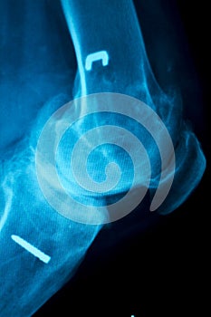 Orthopedic knee implant Xray scan