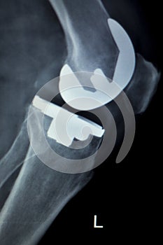 Orthopedic knee implant Xray scan