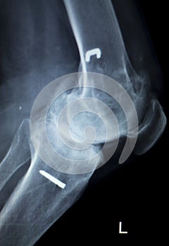 Orthopedic knee implant Xray scan