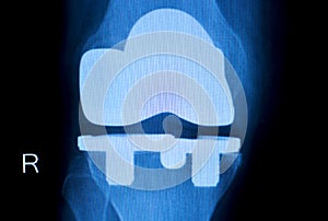 Orthopedic knee implant Xray scan