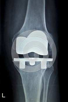 Orthopedic knee implant Xray scan