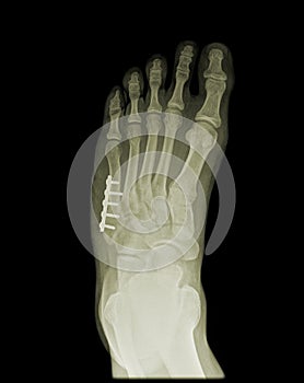 Orthopedic surgery of human foot on x-ray