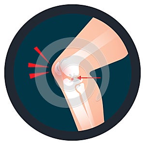 Orthopedics knee icon an injury of ACL or Anterior Cruciate Ligament
