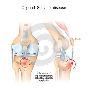 OsgoodÃ¢â¬âSchlatter disease. inflammation of the patellar ligament in knee photo
