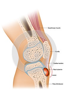 Osgood Schlatter disease or OSD is inflammation of the patellar ligament at the tibial tuberosity photo