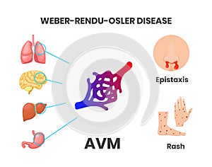Osler-Rendu-Weber disease signs and symptoms