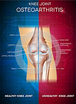 Osteoarthritis