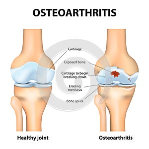 Osteoarthritis or arthritis