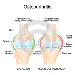 Osteoarthritis. arthritis photo