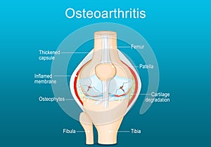 Osteoarthritis. Arthritis of a knee joint