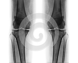 Osteoarthritis both knee .