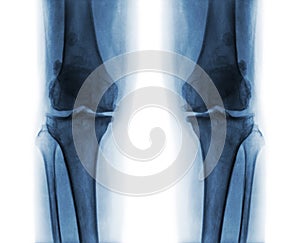 Osteoarthritis both knee .