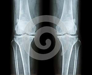 Osteoarthritis both knee . film x-ray AP anterior - posterior of knee show narrow joint space , osteophyte spur , subcond