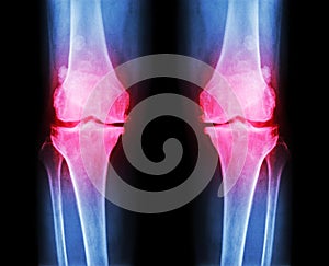 Osteoarthritis both knee . film x-ray AP ( anterior - posterior ) of knee show narrow joint space , osteophyte ( spur ) , subcond