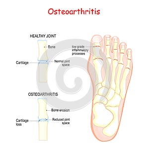 Osteoarthritis. comparison healthy joint and inflammation joint photo