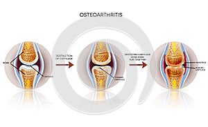 Osteoarthritis detailed illustration