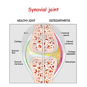 Osteoarthritis. Healthy Synovial joint and knee with Arthritis or pain