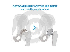 Osteoarthritis of the Hip Joint and Hip Replacement Surgery medical infographic elements isolated on white background