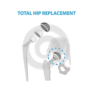 Osteoarthritis of the Hip Joint and Hip Replacement Surgery medical infographic elements isolated on white background