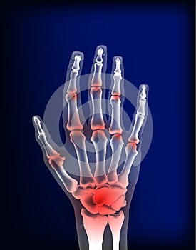 Osteoarthritis image sore inflammation joints of bones the of hand. photo