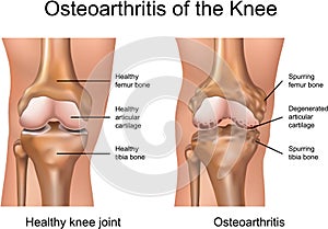 Arthrose aus knie 