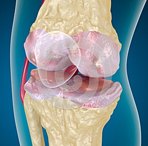 Osteoarthritis : Knee