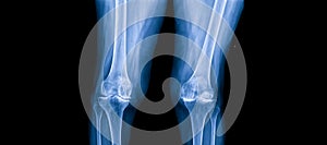 Osteoarthritis of knee in elderly woman.The blue tone of xray shows joint narrowing