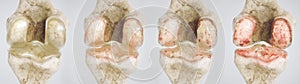 Osteoarthritis of the knee in four stages - high degree of detail - 3D Rendering photo