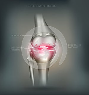 Osteoarthritis knee joint destruction