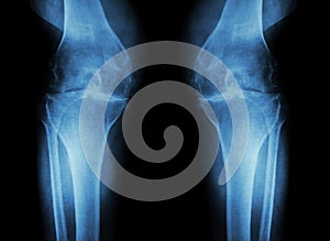 Osteoarthritis Knee ( OA Knee ) ( Film x-ray both knee with arthritis of knee joint : narrow knee joint space ) ( Medical and