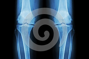 Osteoarthritis Knee ( OA Knee ). Film x-ray both knee ( front view ) show narrow joint space ( joint cartilage loss ) , osteophyte