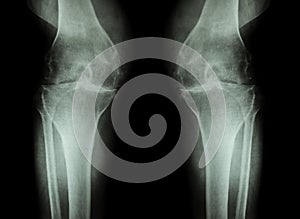 Osteoarthritis Knee ( OA Knee ) ( Film x-ray both knee with arthritis of knee joint : narrow knee joint space ) ( Medical and photo