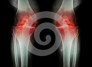 Artrosi ginocchio ( ginocchio ) ( Entrambi ginocchio artrite da ginocchio giunto stretto ginocchio giunto spazio ) ( medico un 
