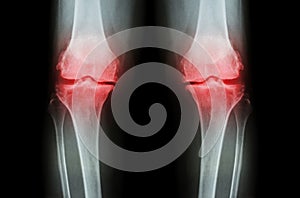 Osteoarthritis Knee ( OA Knee ). Film x-ray both knee ( front view ) show narrow joint space ( joint cartilage loss ) , osteophyte