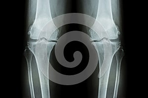 Osteoarthritis Knee ( OA Knee ). Film x-ray both knee ( front view ) show narrow joint space ( joint cartilage loss ) , osteophyte