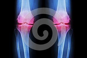 Osteoarthritis Knee ( OA Knee ). Film x-ray both knee ( front view ) show narrow joint space ( joint cartilage loss ) , osteophyte