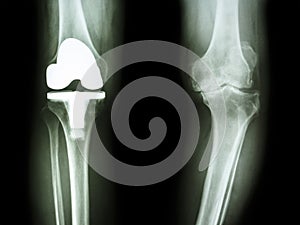 Osteoarthritis knee patient and artificial joint