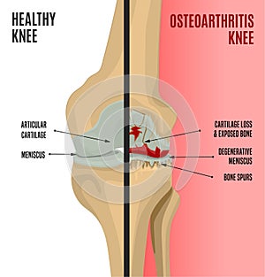 Osteoarthritis Knee Poster